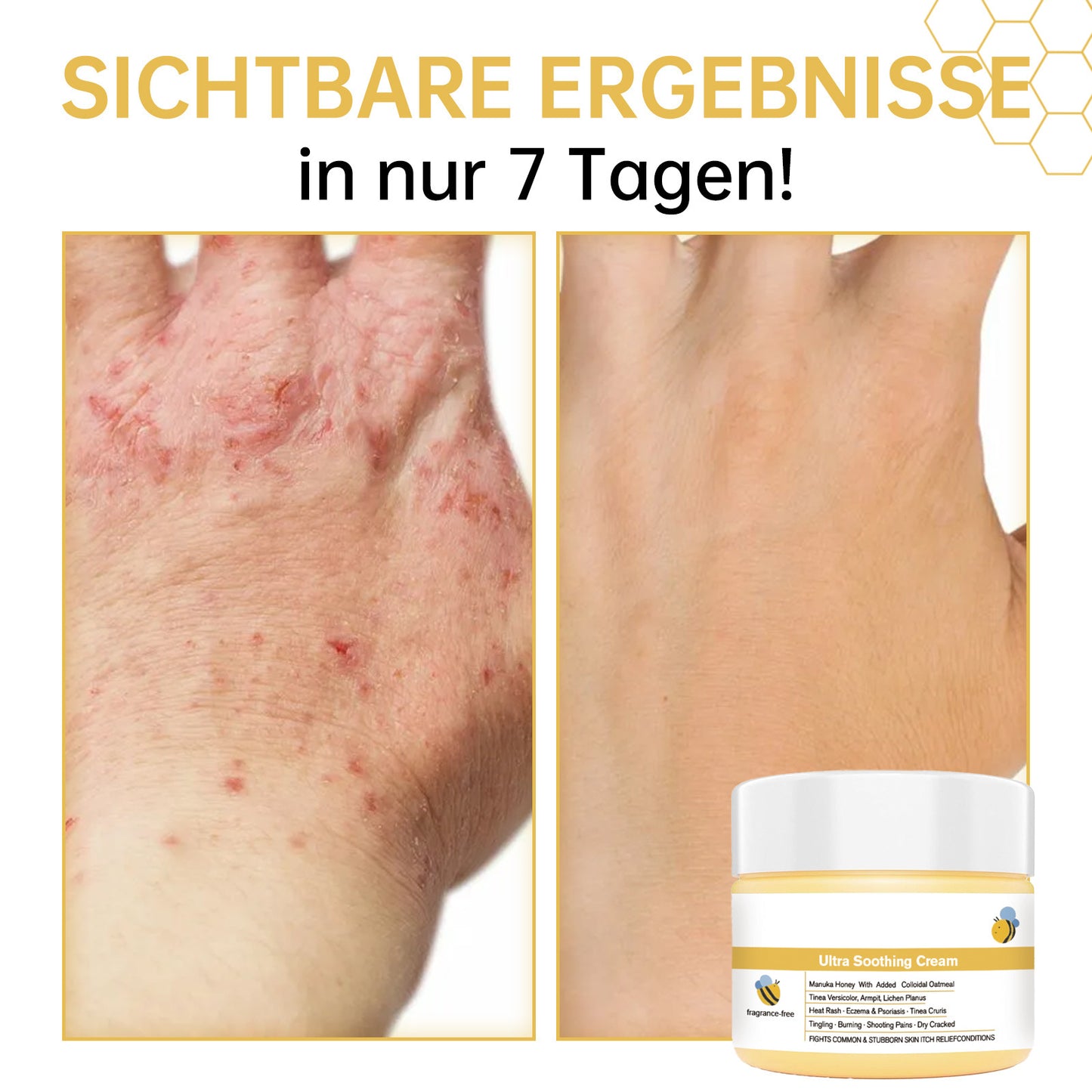 Anti Itch Cream