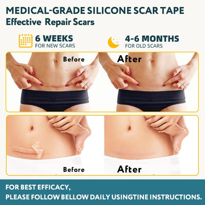 Medical Grade Silicone Scar Treatment Sheets