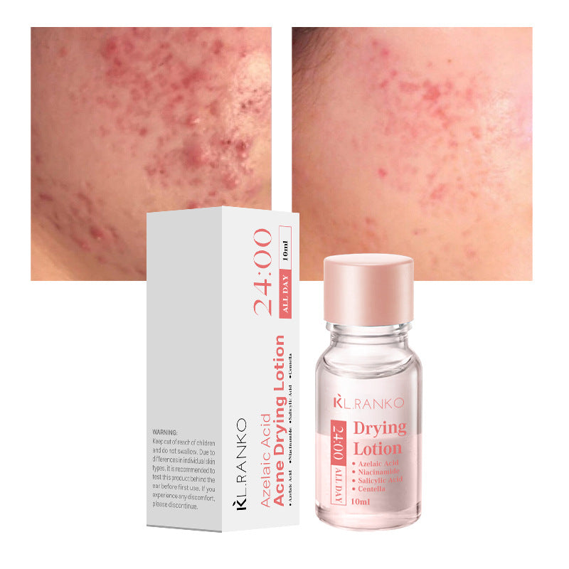 Salicylic Acid Acne Serum