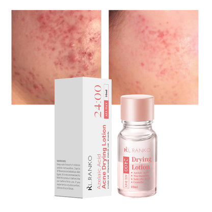 Salicylic Acid Acne Serum