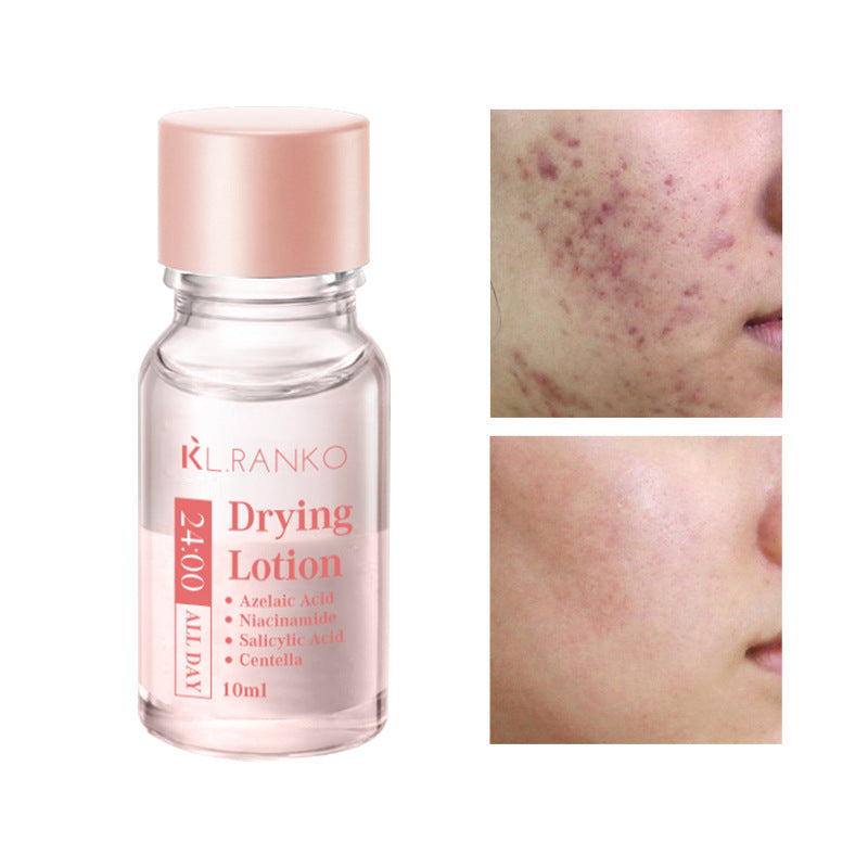 Salicylic Acid Acne Serum