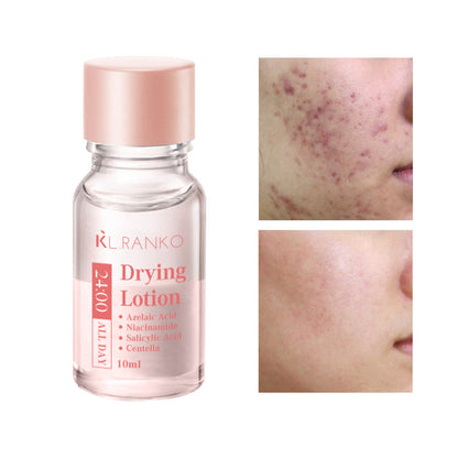 Salicylic Acid Acne Serum