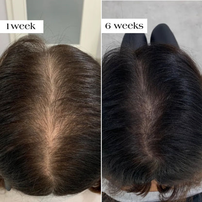 Hair Growth Microneedle Essence for Regrowth and Anti-Hair Loss
