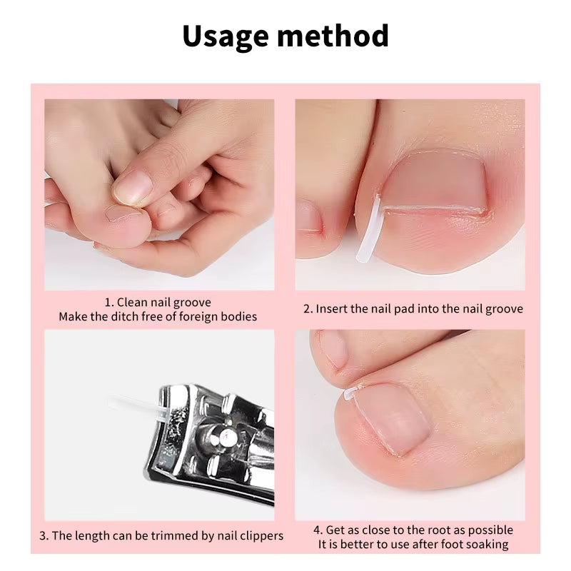 50Pcs Ingrown Toenail Correction Tool Ingrown Toe Nail Treatment Elastic Patch Sticker Straightening Clip Brace Pedicure Tool
